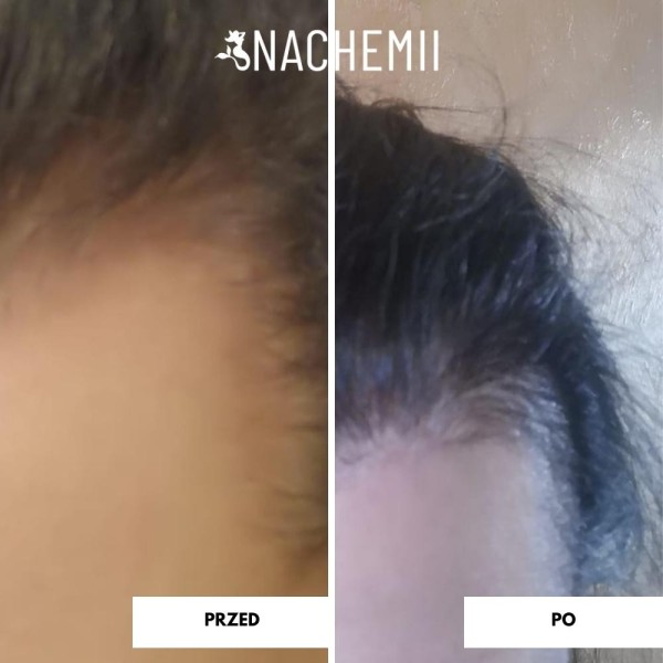 Serum stymulujące porost włosów