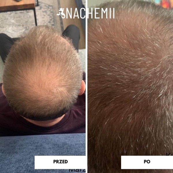 Serum stymulujące porost włosów