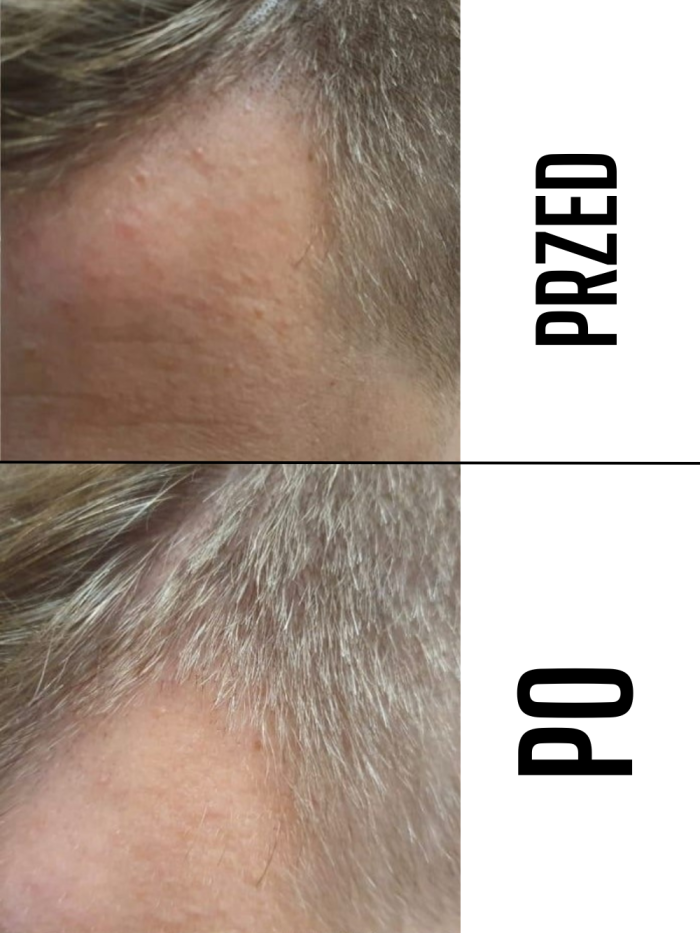 Przed i po — włosy mężczyzn — materiał 5
