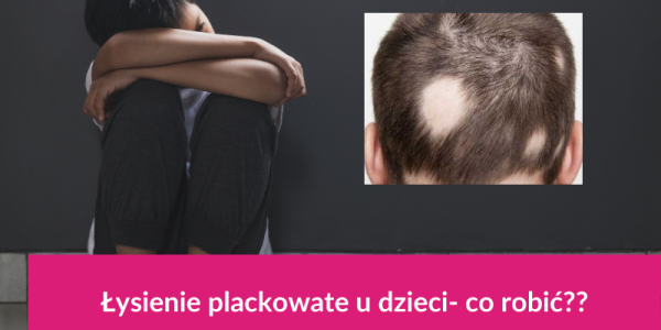 Łysienie plackowate u dziecka – co robić, gdy pojawiają się placki bez włosów? 